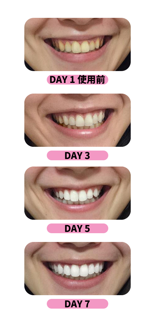 FastWhite齒速白牙齒美白前後對照
