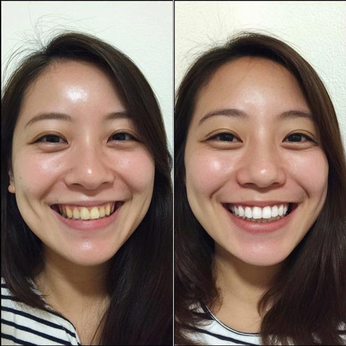 FastWhite齒速白牙齒美白前後